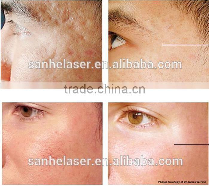 multifunctional easy spa needle fractional rf beauty microneedle rf korea