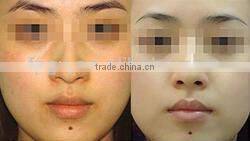 2015 professional IPL Machine for hair removal FP new design