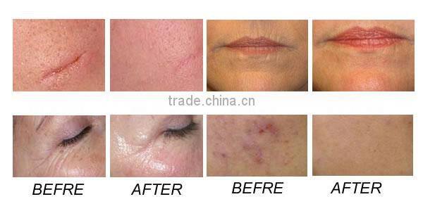 Powerful 60W medical fractional co2 laser scar removal machine/CO2 Carboxy therapy