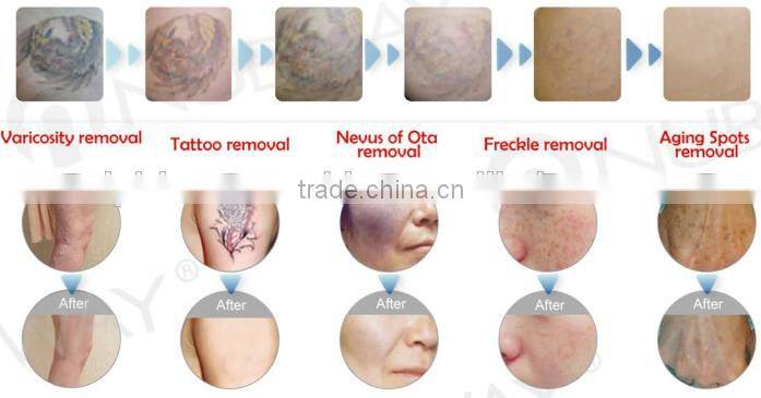 Wavelength 1064nm 532 nm Q switch nd yag laser pulsed dye laser for tattoo removal vascular and skin rejuvenation