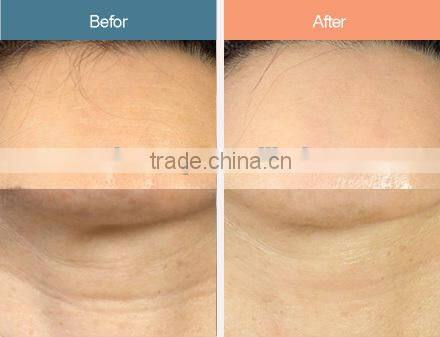 Multi-function beauty facial skin massage machine for wrinkle removal, face lifting -JTLH-1602