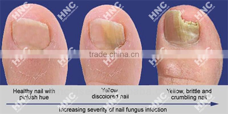 HNC China manufacturer 2014 new invention product 905nm laser Ringworm leuconychia therapy device