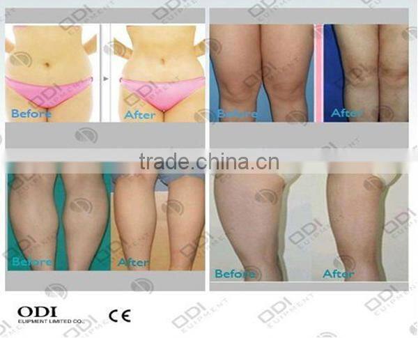 CE certificate Cellulite Removal/Belly Slimming Rf Vacuum Cavitation Weight Loss Machine