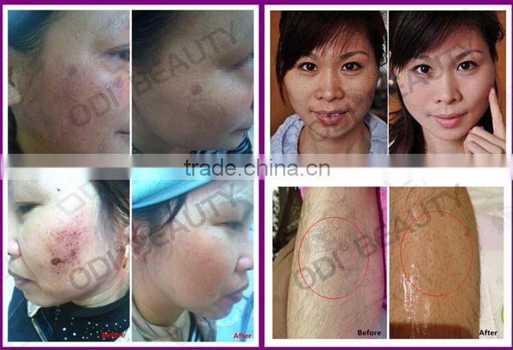 Fast and painless epilation/ facial treatment ipl type super shr