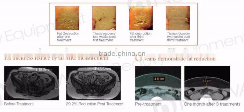 Big promotion ! 250khz hifushape&ultrashape body slimming machine for weight loose