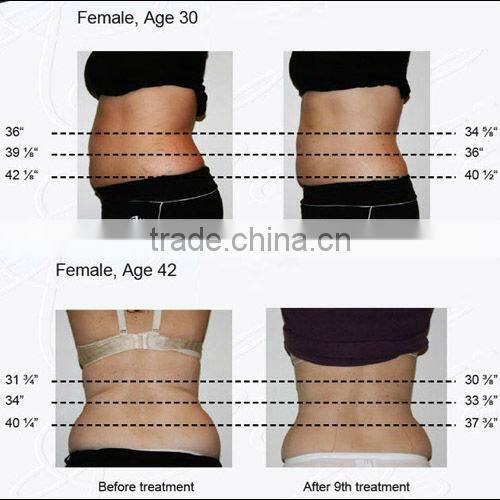 cellulite weight loss HS 560v+ weight loss equipment by shanghai med apolo