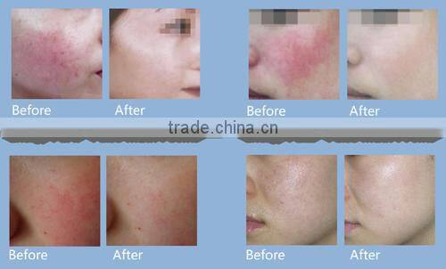 Portable 980nm laser non-invasive veins vascular removal beauty equipment with good effect