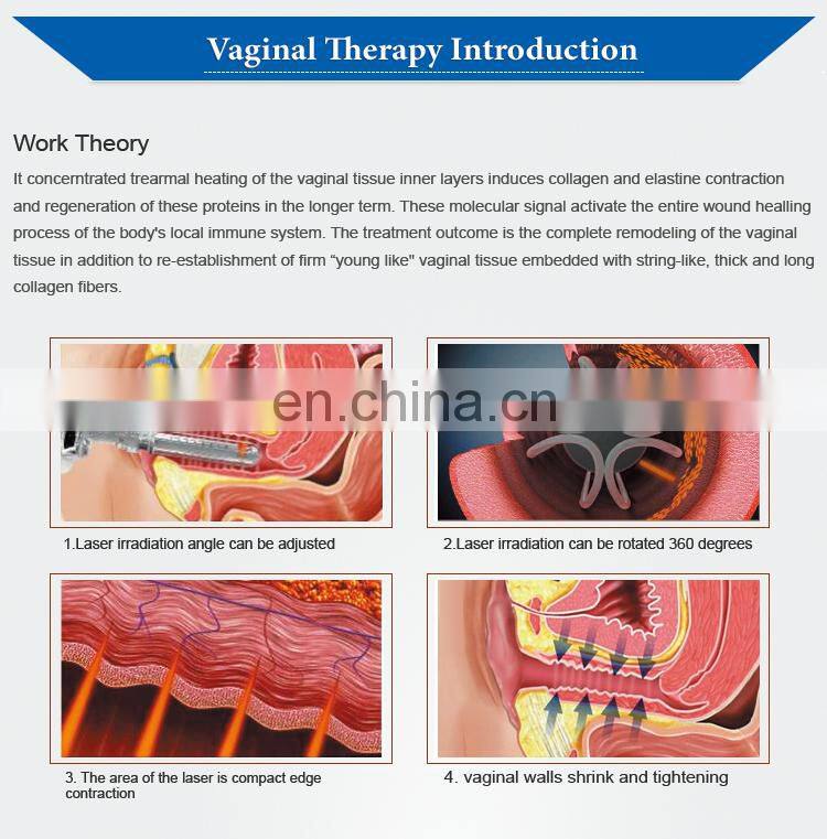 2019 Renlang CO2 Fractional Laser Stretch Mark Removal Vaginal Tightening Machine