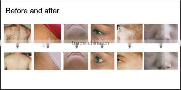 ipl shr machine/shr laser/e-light ipl