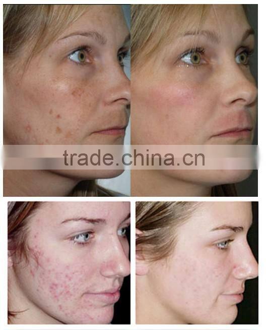 Factory price portable elight ipl rf IPL SHR&E-light hair removal equipment&machine price