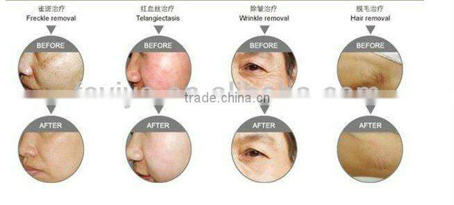 VY-969 Electric Derma Stamp needle cartridge