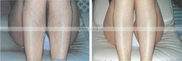 Advanced cooling system painless permanent laser shr IPL hair removal machine