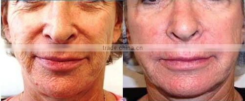 Disposable beauty centrifuge PRP kit