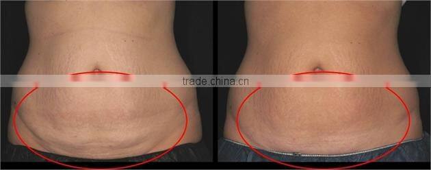 Portable kryolipolyse with two heads weight loss beauty machine