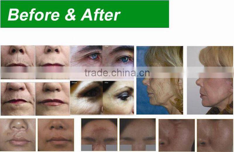 Red Diode Laser Fractional Co2 Laser with scanning probe,cutting probe,vaginal probe