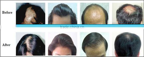 CE approval Newest hair regrowth laser device for beauty spa laser centre
