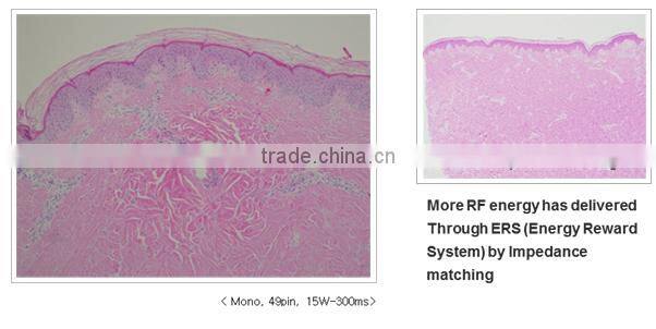 2014 Christmas Promotion!!! 2014 Newest fractional rf/fractional rf microneedle/rf fractional micro needle