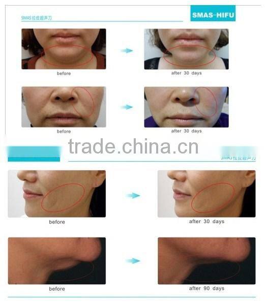Portable Ultrasound Machine High Quality HIFU Face Lift
