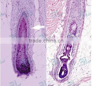 Diode Laser Permanent Hair Removal