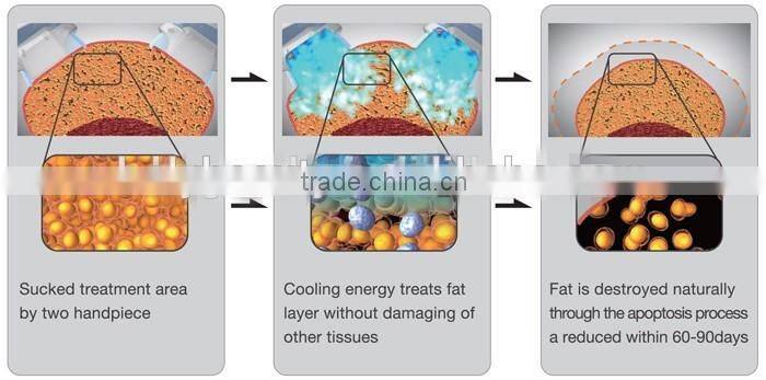 Wholesale 360-Degree cryo lipo fat cell slimming machine