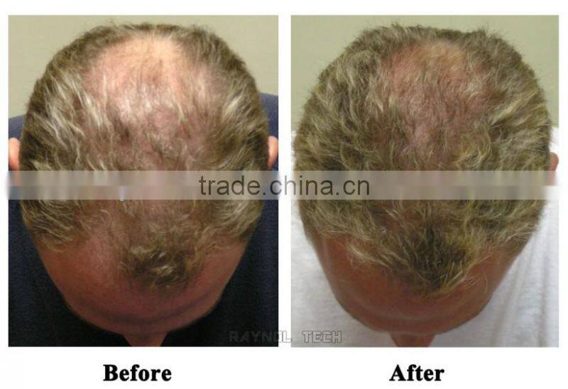 Top Sale 650nm Diode Laser Best Hair Regrowth Machine