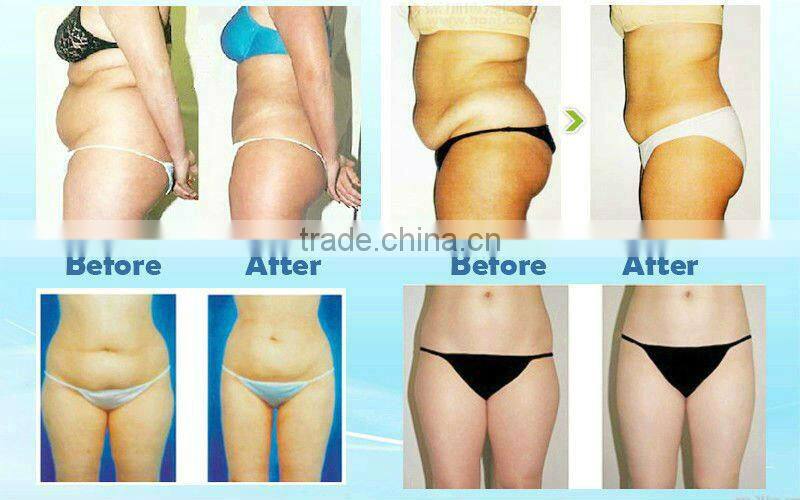 Powerful Skimming device for sale with obvious slimming result (S10)