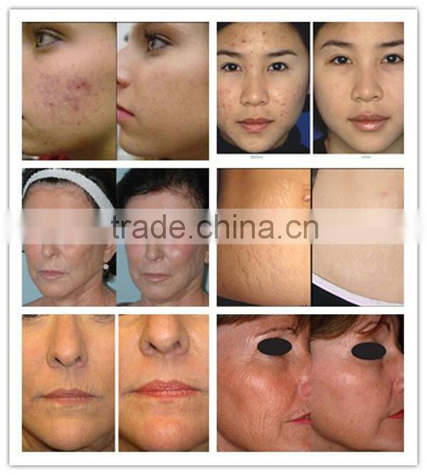 professional co2 laser RF tube price for scar removal and skin resurfacing laser