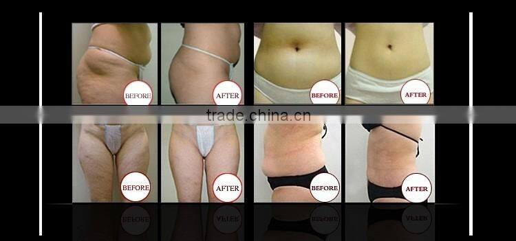 Hottest!! CE Certificated Cryolipolysis Slimming Machine Cryotherapy Freezing Machine Cryolipolysis Machine for Sale