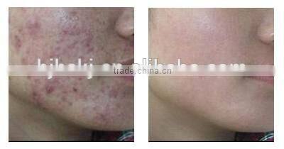 new professional Rhytidectomy skin resurfacing fractional co2 laser ablation