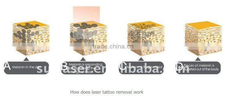 Vertical Q-Switched YAG Laser Tattoo Removal laser vein blood cpillry therpy machine