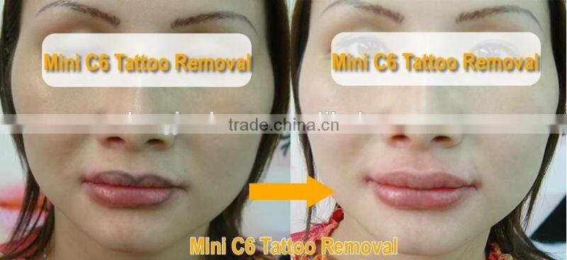 ND yag laser modules / ND yag laser tattoo removal machine