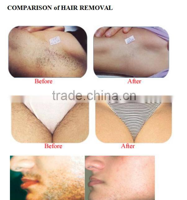 Good Price!! Beauty Device remov tattoo Laser Machine