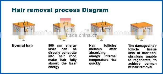 Hot sale and popular diode laser 808 for permanent hair removal