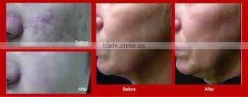 AYJ-Y71A CE acne treatment skin care acne clear removal machine