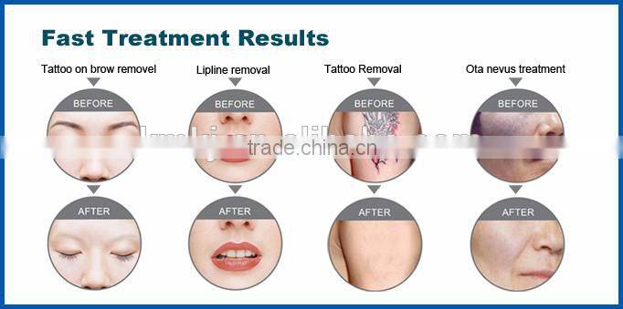 Multifunctional ipl laser rf for hair removal, skin rejuvenation, tattoo removal and weight loss