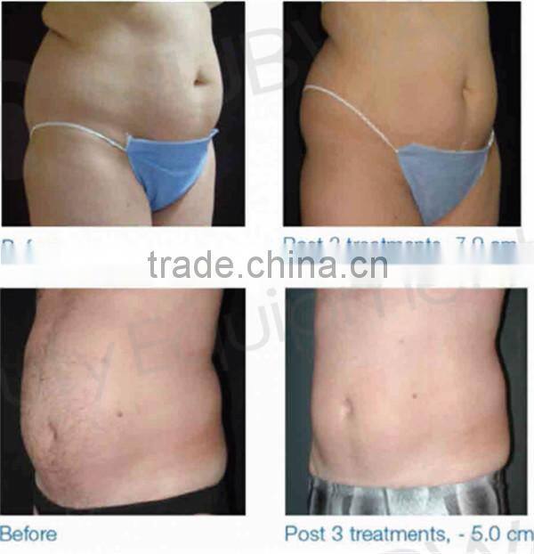 liposonix HIFU System / hifu body machine / fat slim hifu laser 2015 Nubway