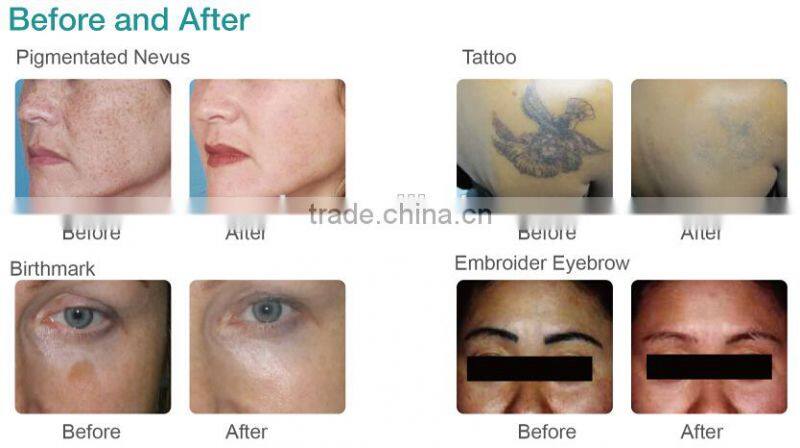 Most effective EO q switch nd yag laser machine for pigment removal