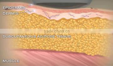 LANGDI fat killer top grade HIFU shape slimming machine