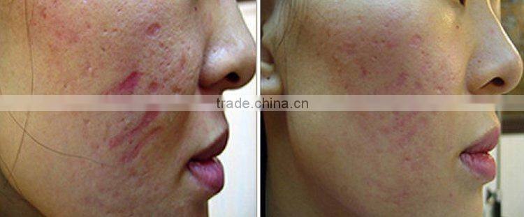 2014 new price LED photon derma roller L001 private label