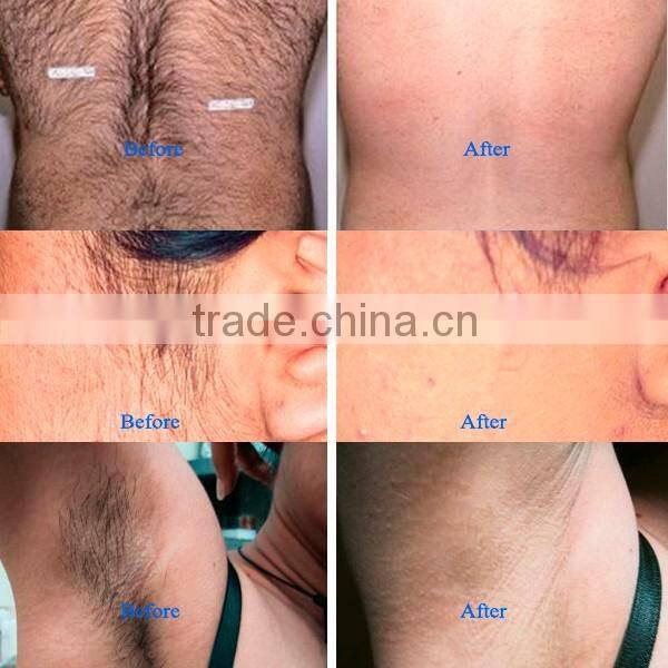 Medical CE K6 approved skin care ipl hair removal skin rejuvenation machine