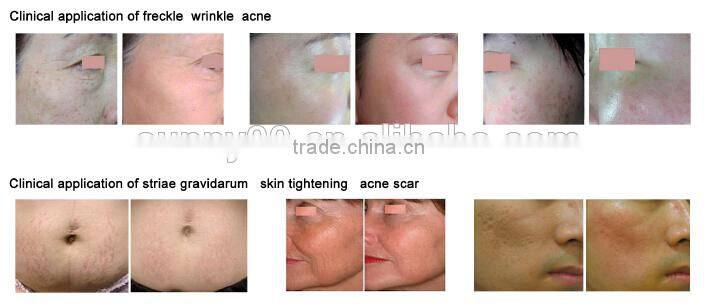 upgrades gold multifunctional co2 fractional laser(aesthetic laser)