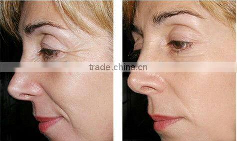 Home and Spa using IPL photofacial machine,IPL hair removal beauty equipment with OEM service -A003