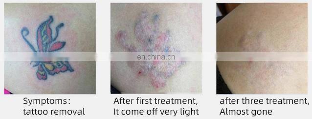 Best profession portable pico second laser eye brow tattoo malasma pigment removal machine
