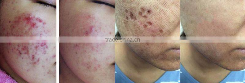 fractional co2 laser 30w-portable type