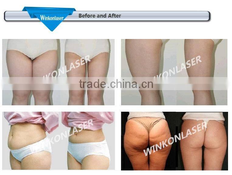 China Factory supply fat removal machine best selling products in america