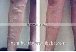 hair loss treatment- medical beauty equipment 1064nm long pulse laser nd yag P003