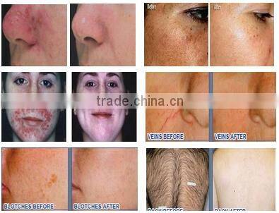 Hottest sale product !!!! professional ipl hair removal machine ipl trolley