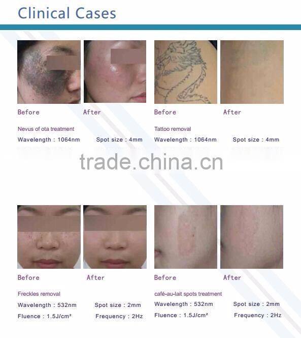 Q-switch 1000W big spot Nd Yag Laser for tattoo pigment remaoval FDA approved