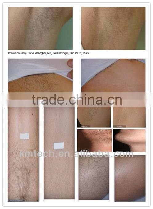 professional dilas 808nm diode laser hair removal machine