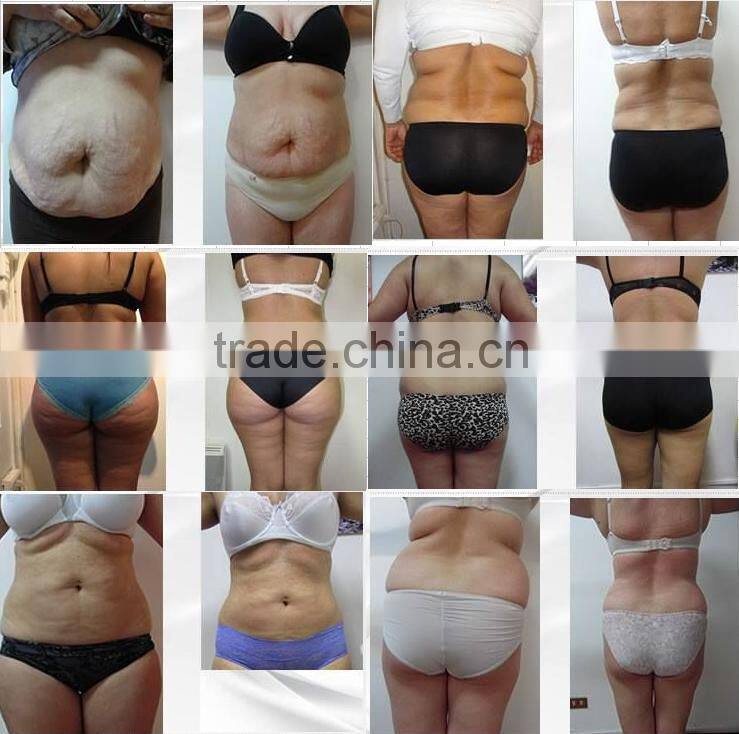 635nm/650nm/810nm/940nm Dual Wave lipo laser machine /lipolaser /lipo laser